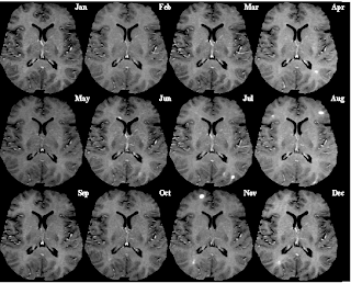 Multiple Sclerosis: T1-weighted MRI (post-contrast)