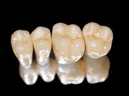 răng sứ titan kim loại