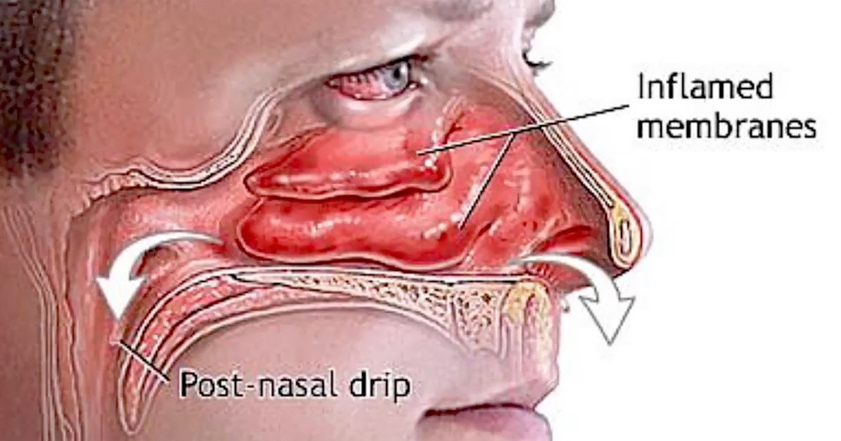 Clear Out Your Sinuses Using Only Your Fingers In A Matter Of Seconds