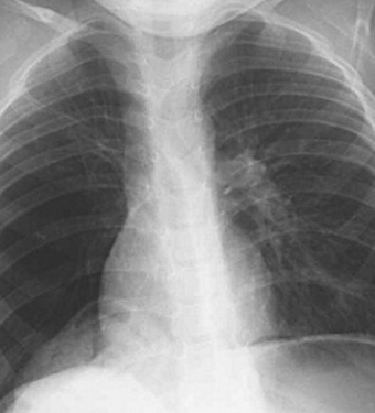 Mesocardia Definiton, ECG, Causes, Treatment | Mesocardia vs Dextrocardia