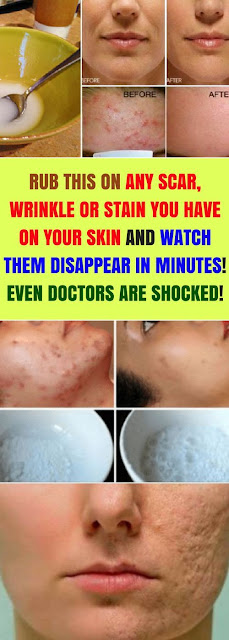 RUB THIS ON ANY SCAR, WRINKLE OR STAIN YOU HAVE ON YOUR SKIN AND WATCH THEM DISAPPEAR IN MINUTES! EVEN DOCTORS ARE SHOCKED!