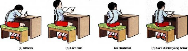 cara-duduk-kifosis-lordosis-skoliosis, cara duduk yang benar, cara duduk yang salah, cara duduk kifosis, cara duduk lordosis, cara duduk skoliosis, akibat duduk yang salah, posisi duduk yang salah, solusi duduk yang salah