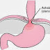 Achalasia : Symptoms , Treatment , Definition , Causes , Diagnosis