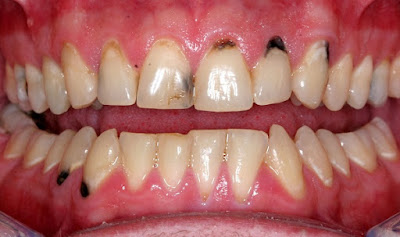 Răng sứ titan có bị đen sau khi bọc không?