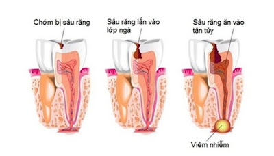 Nguyên nhân răng sâu bị đen - Phân tích từ nha sĩ-2