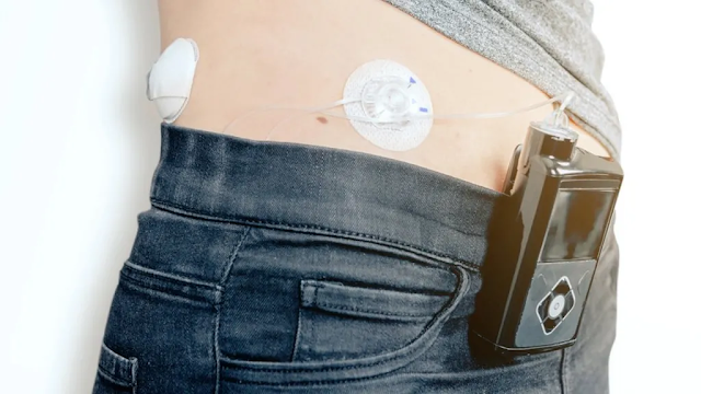 automate-insulin-pump