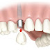 Trồng răng implant có nguy hiểm không?