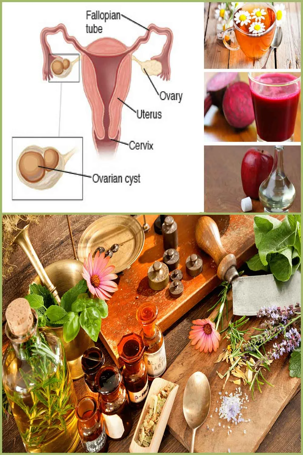 Remèdes maison à base de plantes pour les kystes ovariens