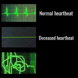 NORMAL DECEASED HEARTBEAT