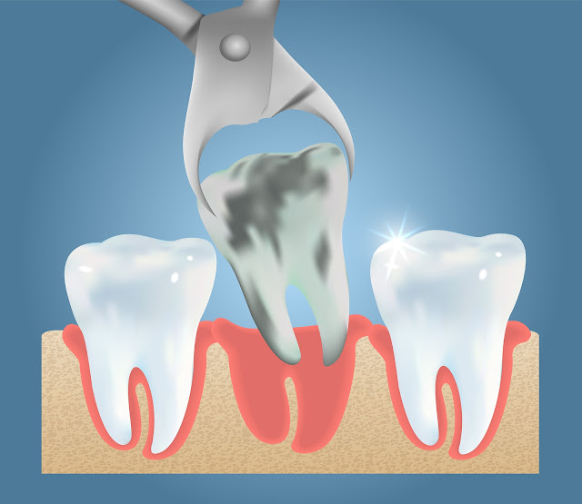 Cyst Wisdom Tooth Removal