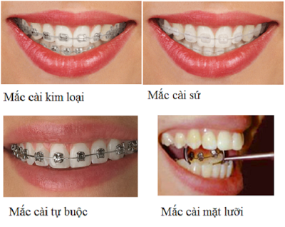 Vì sao nên thực hiện niềng răng?