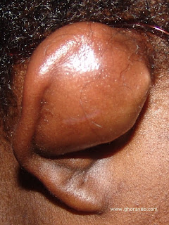 Hematoma auricular