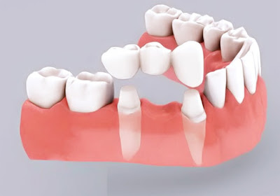 Trồng răng hàm bao nhiêu tiền với từng phương pháp 2