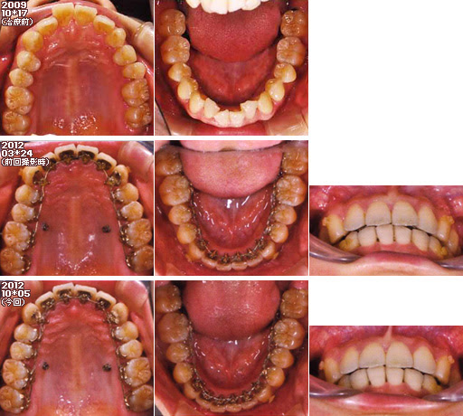 歯列矯正：定期検診その29