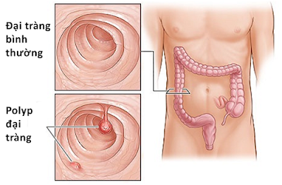 polyp đại tràng trực tràng