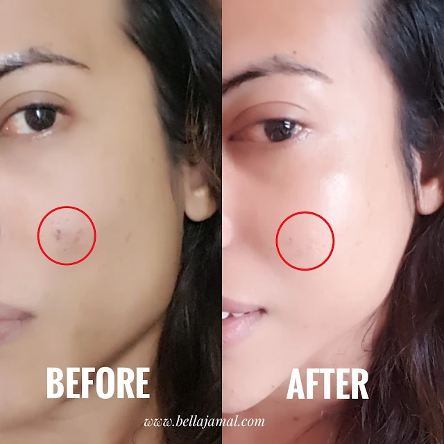 PRP Treatment Review At Premier Clinic: Stay Young & Beautiful