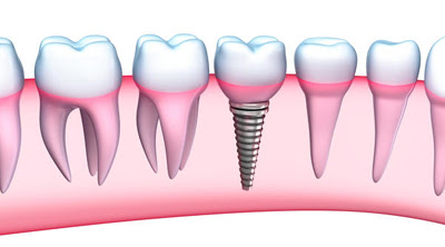 Chi phí trồng răng implant bao nhiêu?