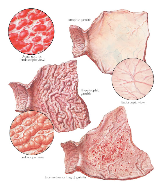 GASTRITIS