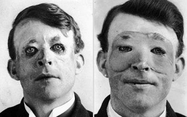 first plastic surgery and skin transplant 1917