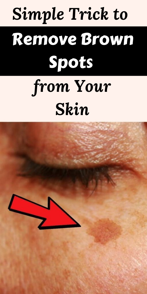 Healthy Discuss Simple Trick To Remove Brown Spots From Your Skin