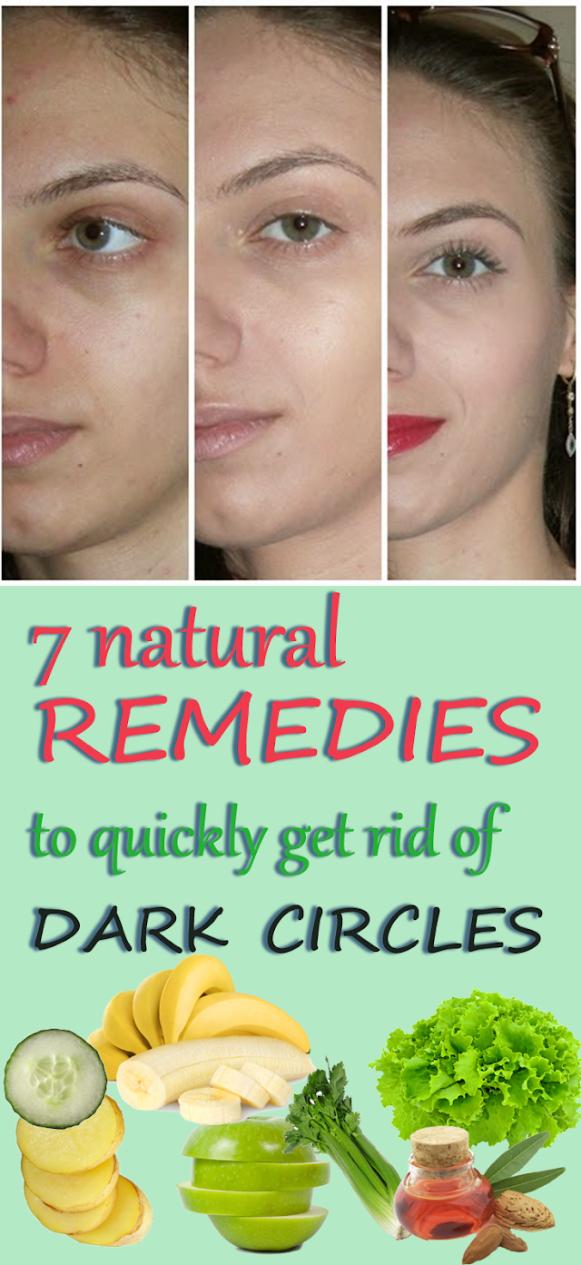 7 Natural Remedies to Quickly get rid of Dark Circles
