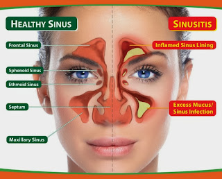 Obat Sinusitis Kronis