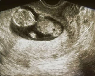 15 haftalık gebelik ultrason görüntüleri