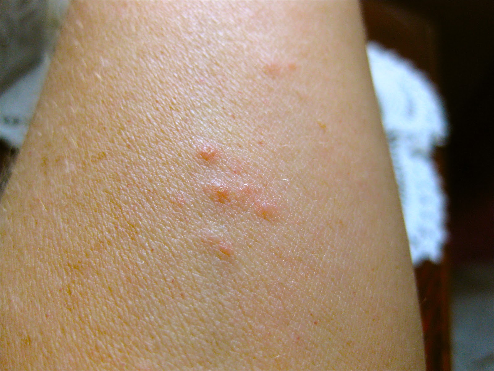 ... do a google images search to see many photographs of bed bug bites