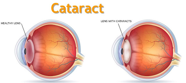 Cataract Surgery in Ahmedabad