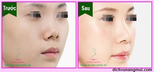 Câu hỏi: Thu gọn cánh mũi ở đâu đẹp - Trước và sau