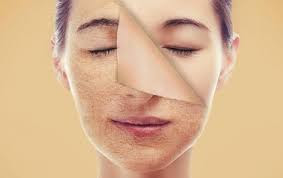 Da mặt sần sùi nhiều mụn cám có khắc phục được không? 1