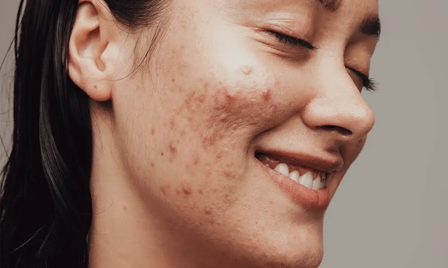 All the Information You Require about Acne