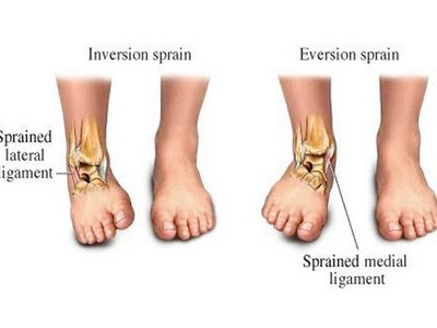 SPRAINS with Get Rid Of The Foot Pain reviews