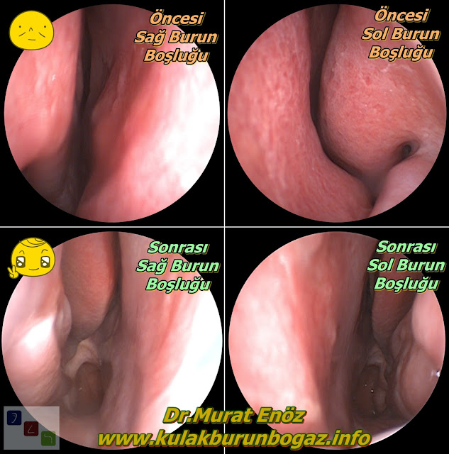 Before and After Photos for Turbinate Radiofrequency - Before and After Photos for Septoplasty - Before and After Photos for Turbinate Radiofrequency in Istanbul - Before and After Photos for Turbinate Radiofrequency Reduction in Istanbul - Before and After Photos for Turbinate Radiofrequency Reduction in Turkey