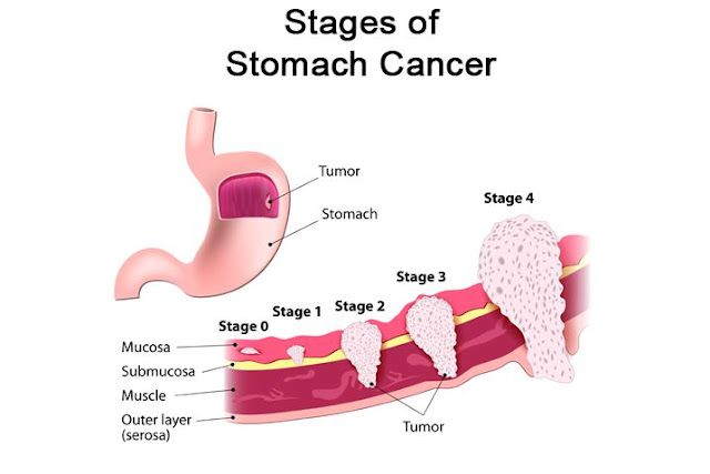 Stage-4-Stomach-Cancer-Symptoms