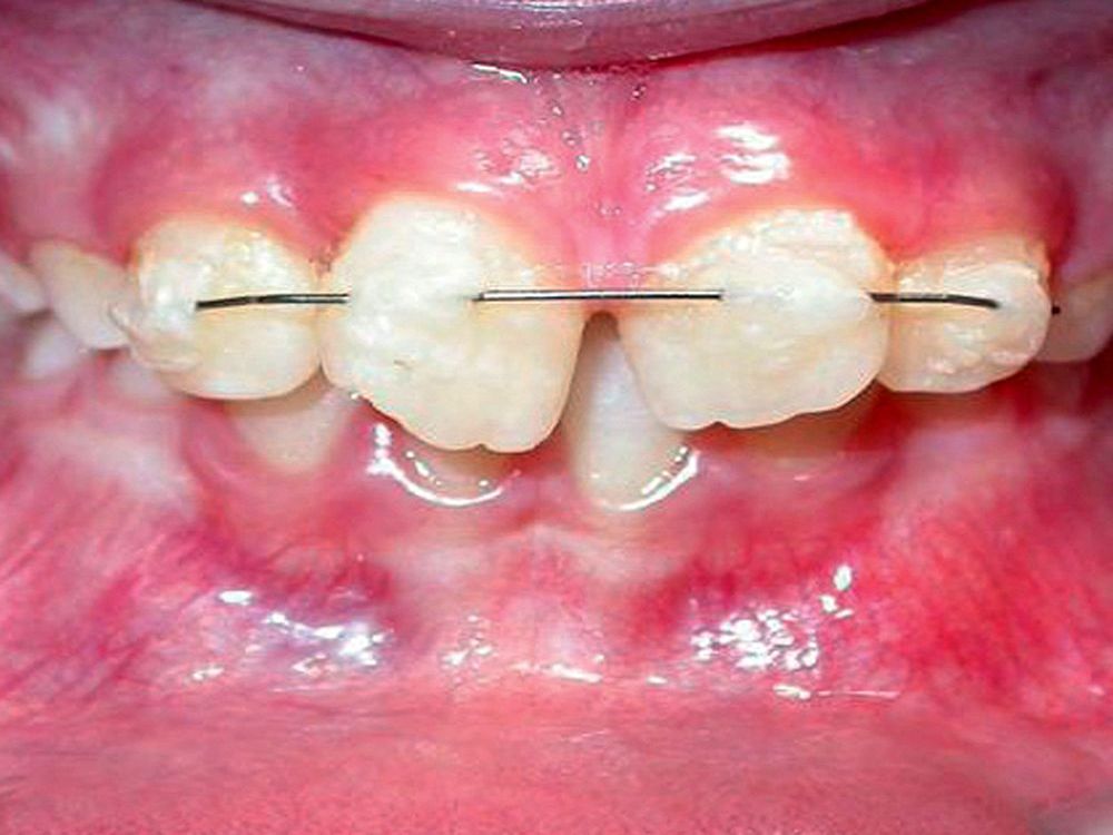 Reimplantación Dental