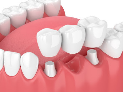 Có nên trồng răng cấm không với cầu răng sứ? 1