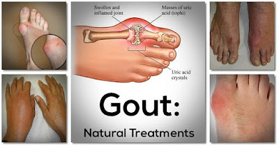 kiến thức bệnh gout