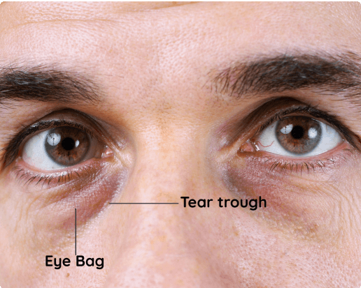 Remove Tear Trough in 1 Week !!! Without Fillers 