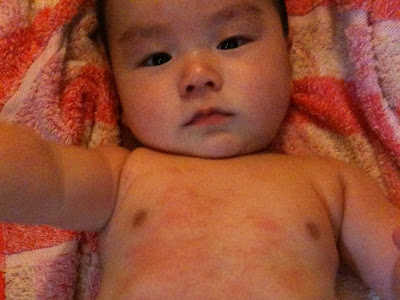 200以上 赤ちゃん 風呂上がり 湿疹 背中 317862-赤ちゃん 風呂上がり 湿疹 背中
