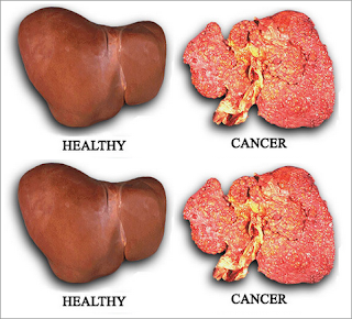 Cara Mengobati Kanker Hati Stadium Akhir
