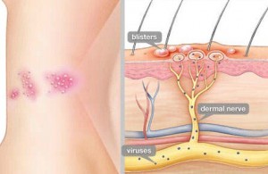 Ciri Penyakit herpes