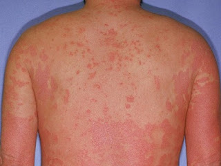 Causas de La Psoriasis