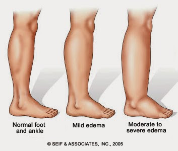 kategori kaki sembap ketika mengandung perlukan makanan berkhasiat