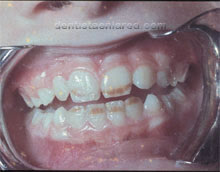 <Img src ="cambios-esmalte-de-los-dientes-por-fluorosis.jpg" width = "220" height "172" border = "0" alt = "Manchas en el esmalte por fluorosis.">