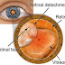 Cara Mengobati Retina Mata Lepas