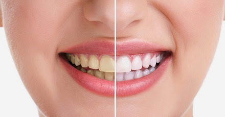Cara Proses Memutihkan Gigi Secara Alami Cara Proses Memutihkan Gigi Secara Alami