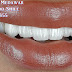 Blog Teeth whitening dentist cost london 