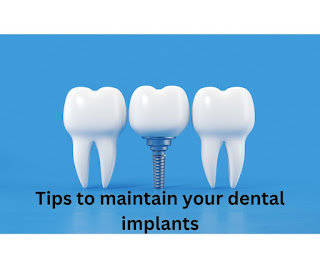 4 Tips to maintain dental implants