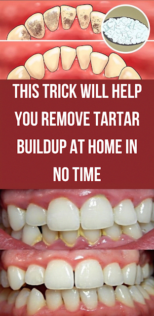 This Trick Will Help You Remove Tartar Buildup At Home In No Time